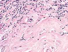 LARGE-CELL NON-HODGKIN LYMPHOMA OF
