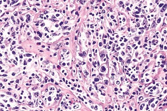 observed 3 such cases in the anterior mediastinum Tumor cells are