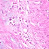 WHO 2016 Criteria Plasmacytoid Carcinoma NO extracellular mucin Similar to diffuse type gastric CA or lobular breast CA Mucinous AdenoCA with Signet-Ring Cells Extracellular mucin Similar to mucinous