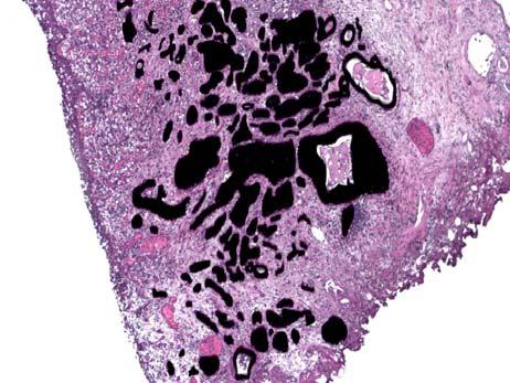 Invasive Urothelial Carcinoma: Nested