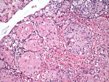 Invasive Urothelial Carcinoma: