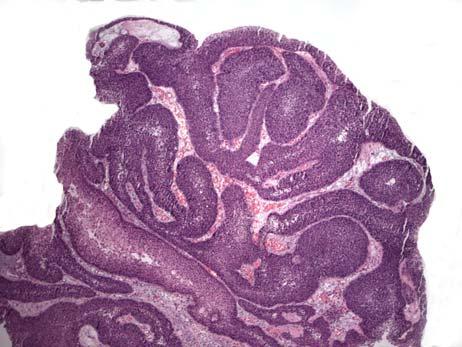 Non-Invasive Endophytic Urothelial Carcinoma Deceptively