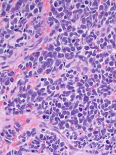 Large Cell Neuroendocrine
