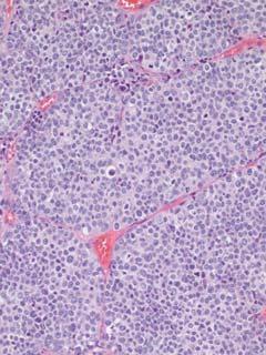 Carcinoma Synaptophysin Small