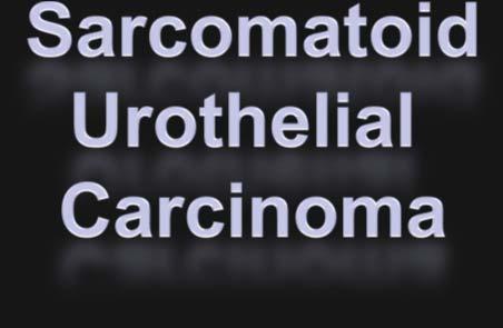 Sarcomatoid Carcinoma Most common malignant spindle