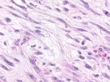 Myofibroblastic Proliferations: Nomenclature Diagnostic Term Clinical Setting Postoperative Spindle Cell Nodule Myofibroblastic Pseudosarcomatous Stromal Proliferation