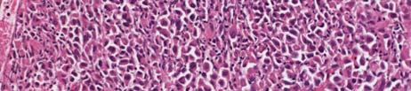 Plasmacytoid Carcinoma