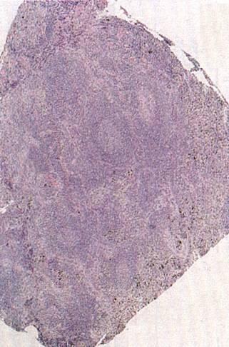 Mantle Cell Lymphoma Neoplasm of Mantle B cells Male predominance Nodal, extranodal,