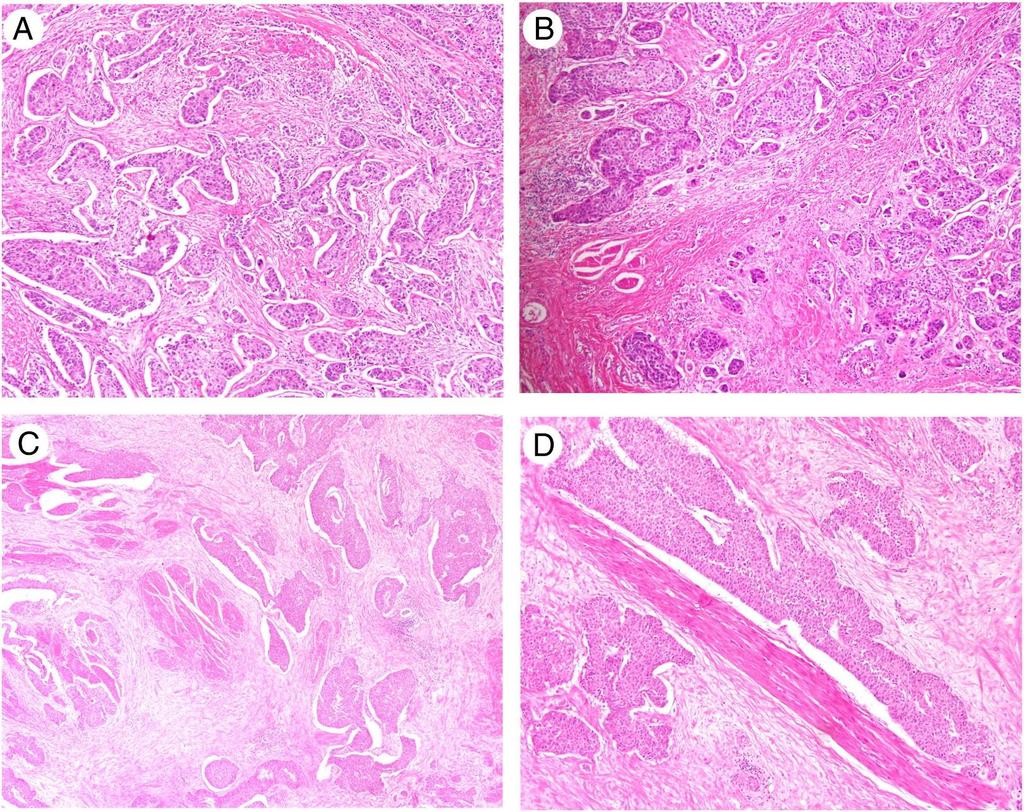 Clinical significance of prominent retraction clefts in invasive urothelial carcinoma Prominent retraction