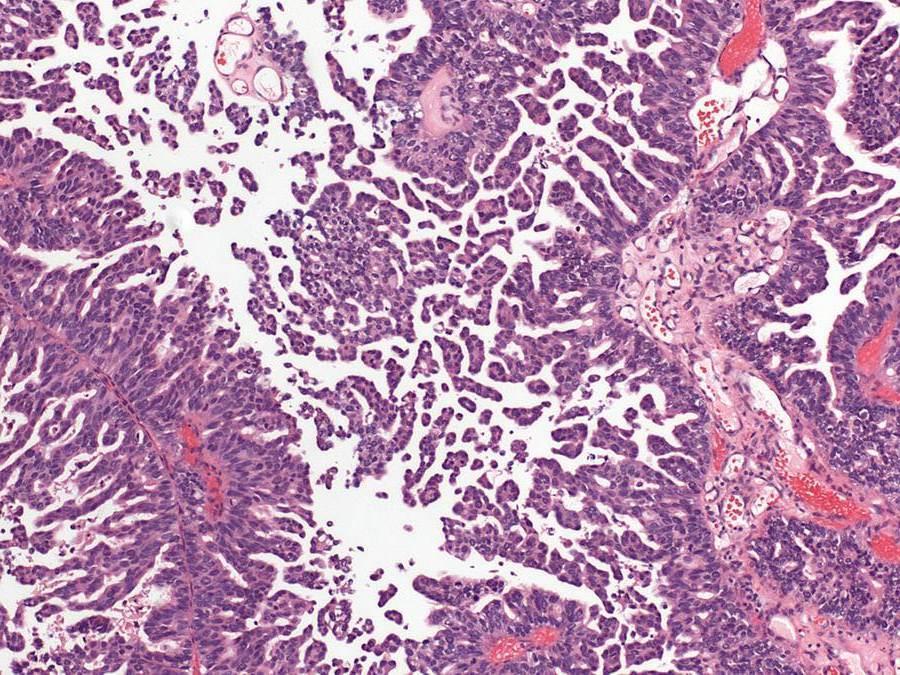 Non-Invasive Micropapillary Urothelial Carcinoma Reminiscent of