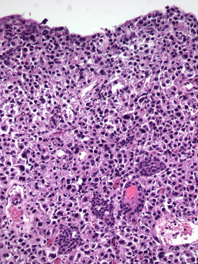 ; age 46-81 Plasmacytoid Urothelial