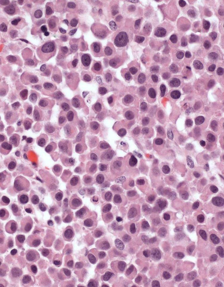 Plasmacytoid Urothelial Carcinoma Dyscohesive oval/round cells in a loose myxoid stroma Abundant