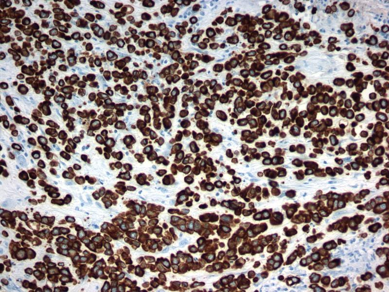 Plasmacytoid Urothelial Carcinoma