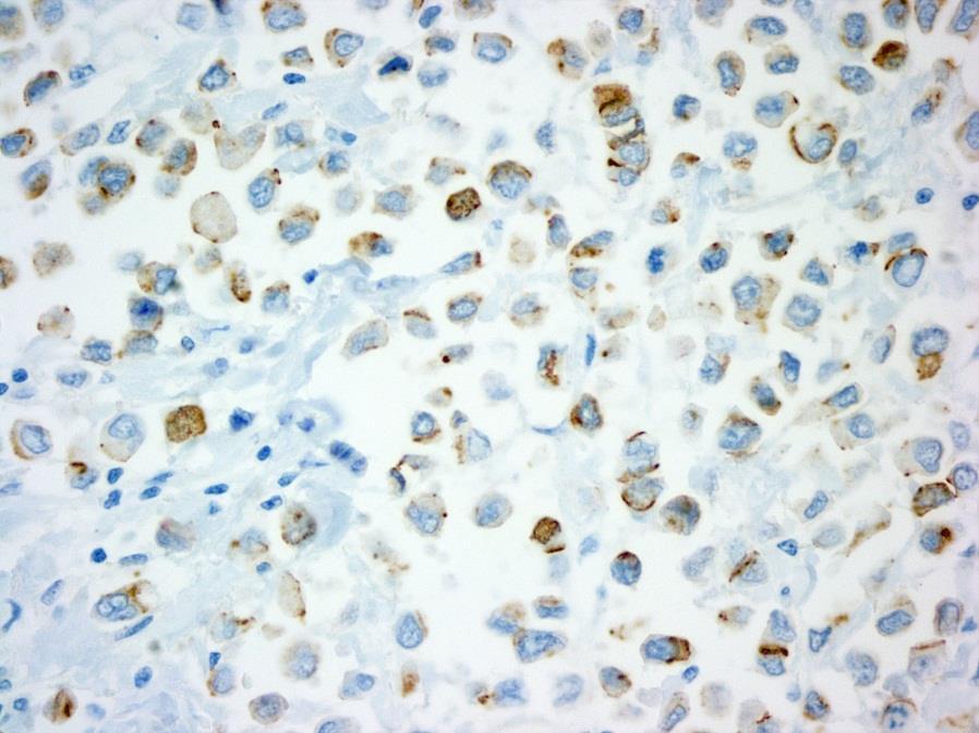 Plasmacytoid Urothelial Carcinoma Immunohistochemistry CCND1 and SNAI1 loss is common; could contribute to aggressive behavior Loss of membranous