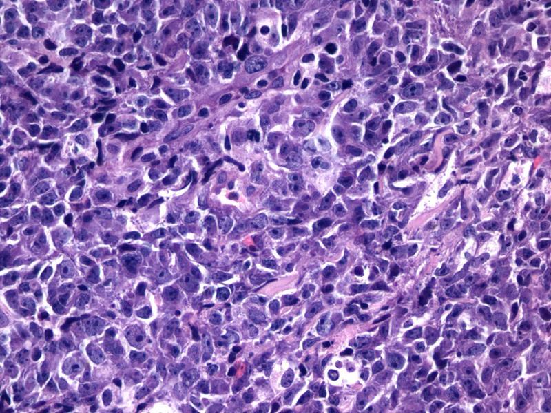 Plasmacytoid Urothelial Carcinoma Differential Diagnosis Plasmacytoid
