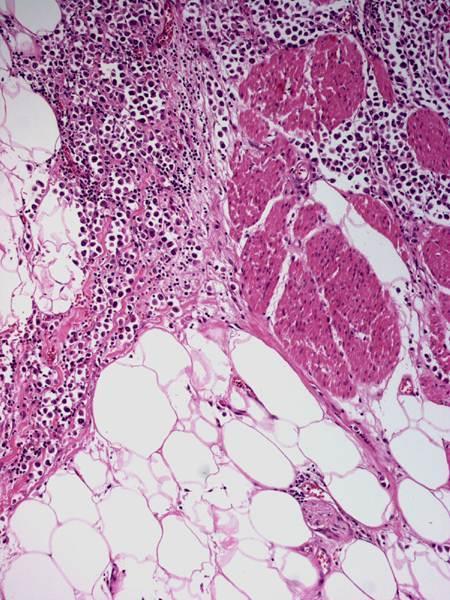 Plasmacytoid Urothelial Carcinoma Prognosis is uniformly poor with advanced stage at