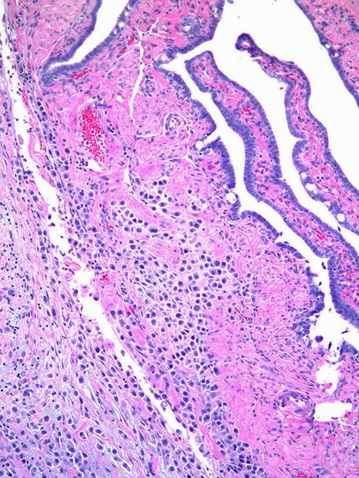 Plasmacytoid Urothelial Carcinoma Unique pattern of spread along ureter and fascial sheath Unusual disease spread - Peritoneal (33%) - Bowel serosa and