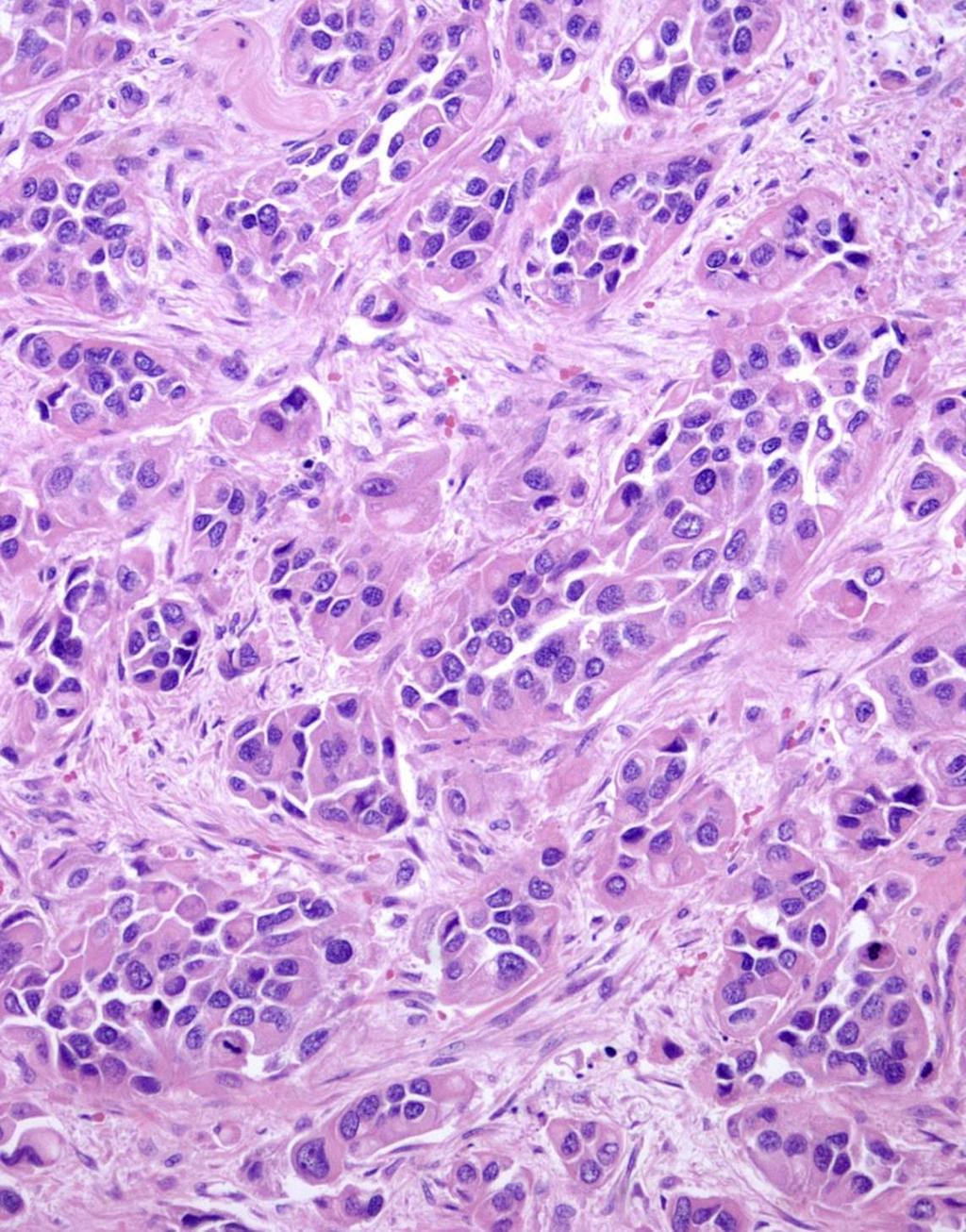 Undifferentiated carcinoma with rhabdoid features Rare tumor, muscle invasive (18 cases reported) Conventional UC component frequently