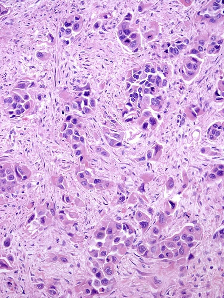 Undifferentiated carcinoma with rhabdoid features Discohesive appearance Sheets of cells