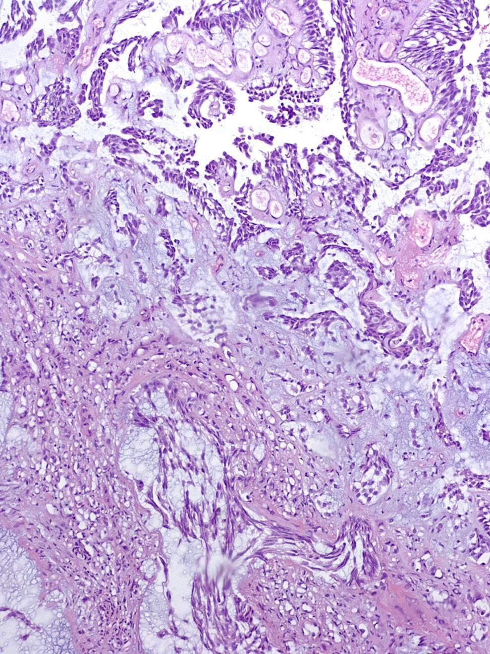 UC with chordoid features UC with unique chordoid morphology; - Cellular cording - Myxoid stromal matrix Reminiscent of chordoma, extraskeletal myxoid