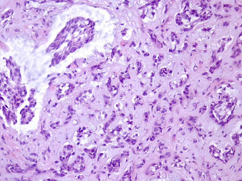 UC with chordoid features NO sarcomatous differentiation NO