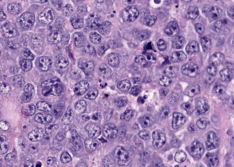 Diffuse large B-cell lymphoma, NOS Definition: Diffuse large B-cell lymphoma is a