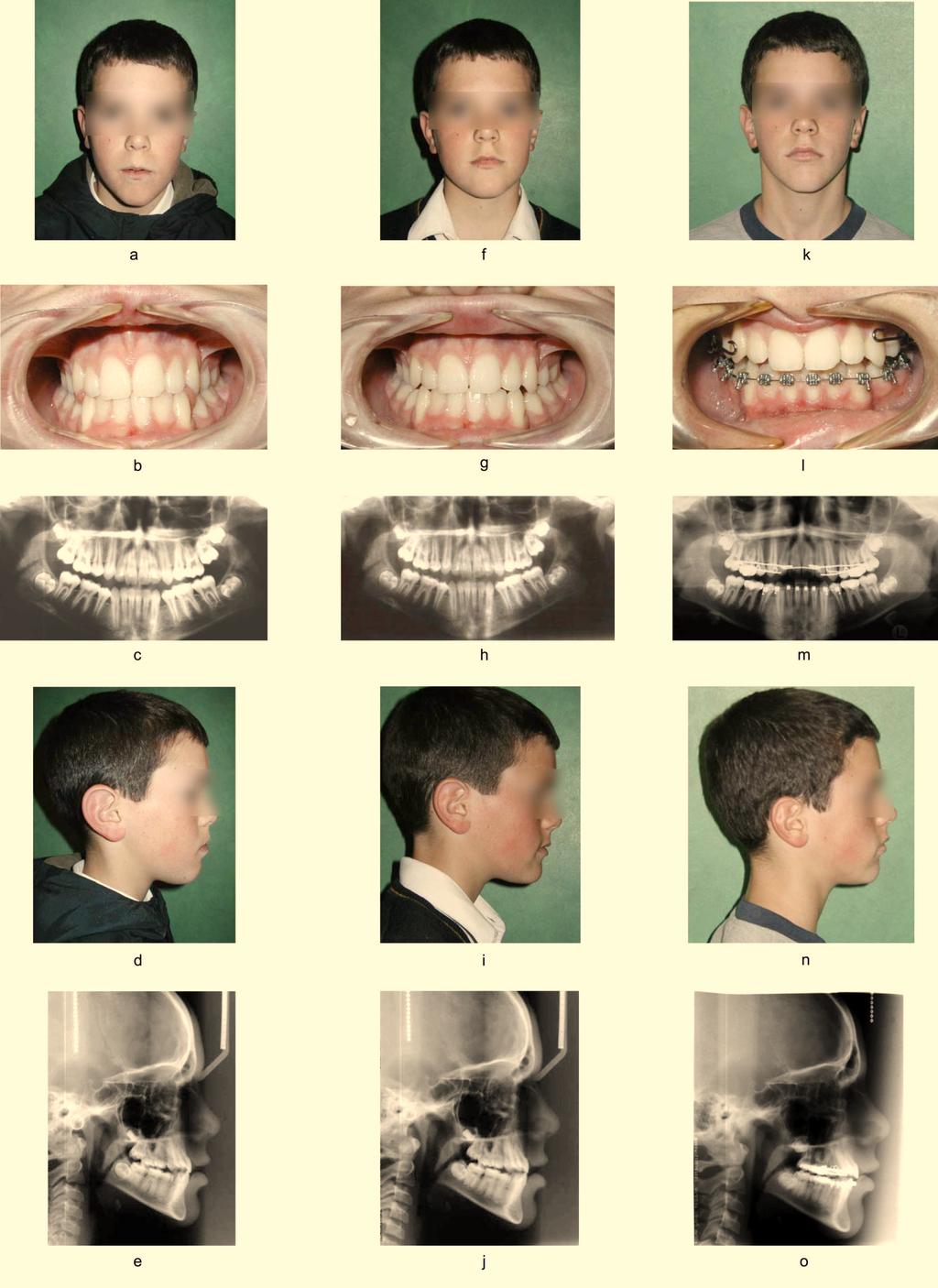 44 The Open Rehabilitation Journal, 2009, Volume 2 Wurgaft and Wong The higher contact in the right side was left until there was no pain during mouth opening; no click and no mandibular deviation