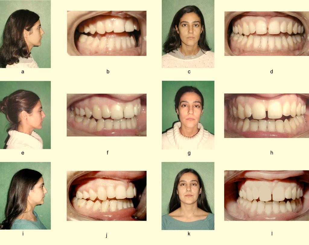 As the interdental lingual interposition may produce malocclusion such as open bite, a functional re-education of the tongue can change the lingual position and help to correct the open bite.