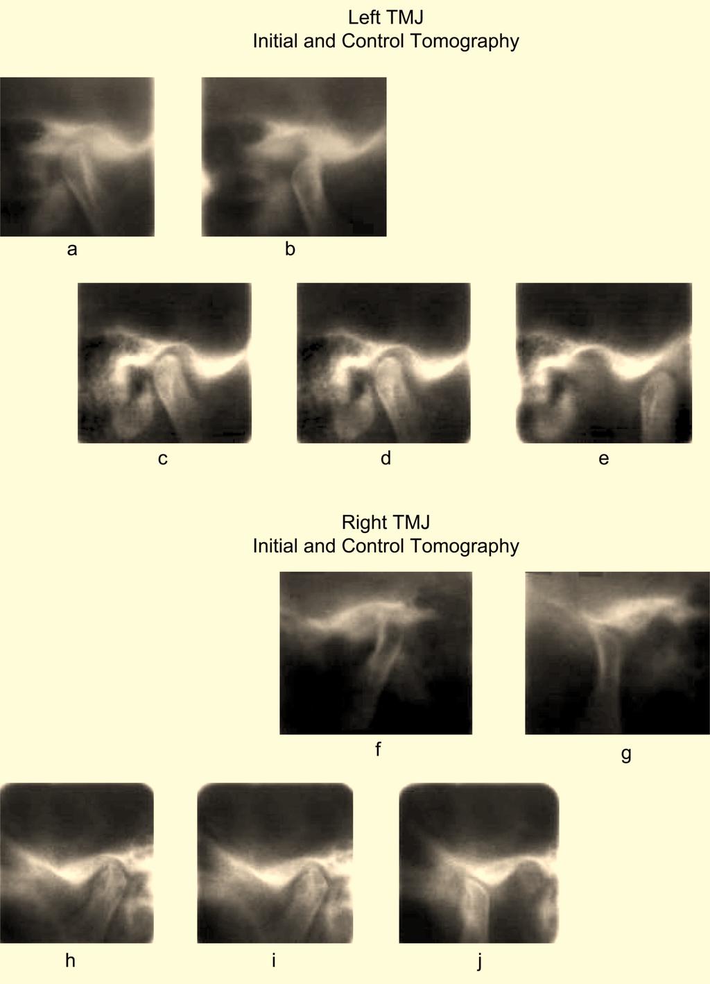 Temporomandibular Joint Remodeling The Open Rehabilitation Journal, 2009, Volume 2 47 Fig. (5). Case 2 TMJ radiographs. demonstrated in clinical studies in occlusal equilibration [11].