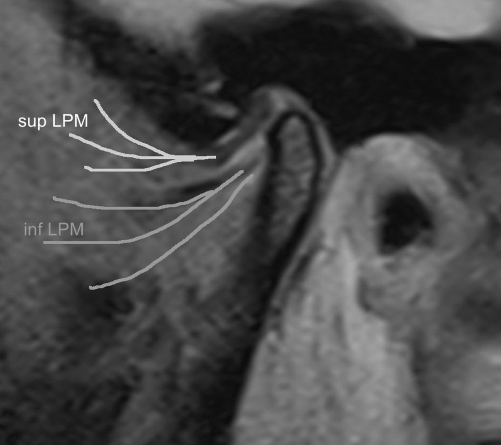 Fig. 4: sup LPM: superior head of the lateral pterygoid