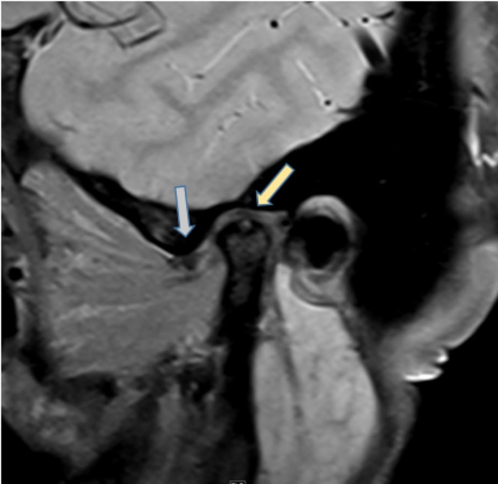 Fig. 12: Anterior displacement of the disc (mouth closed and open) (grey arrow).