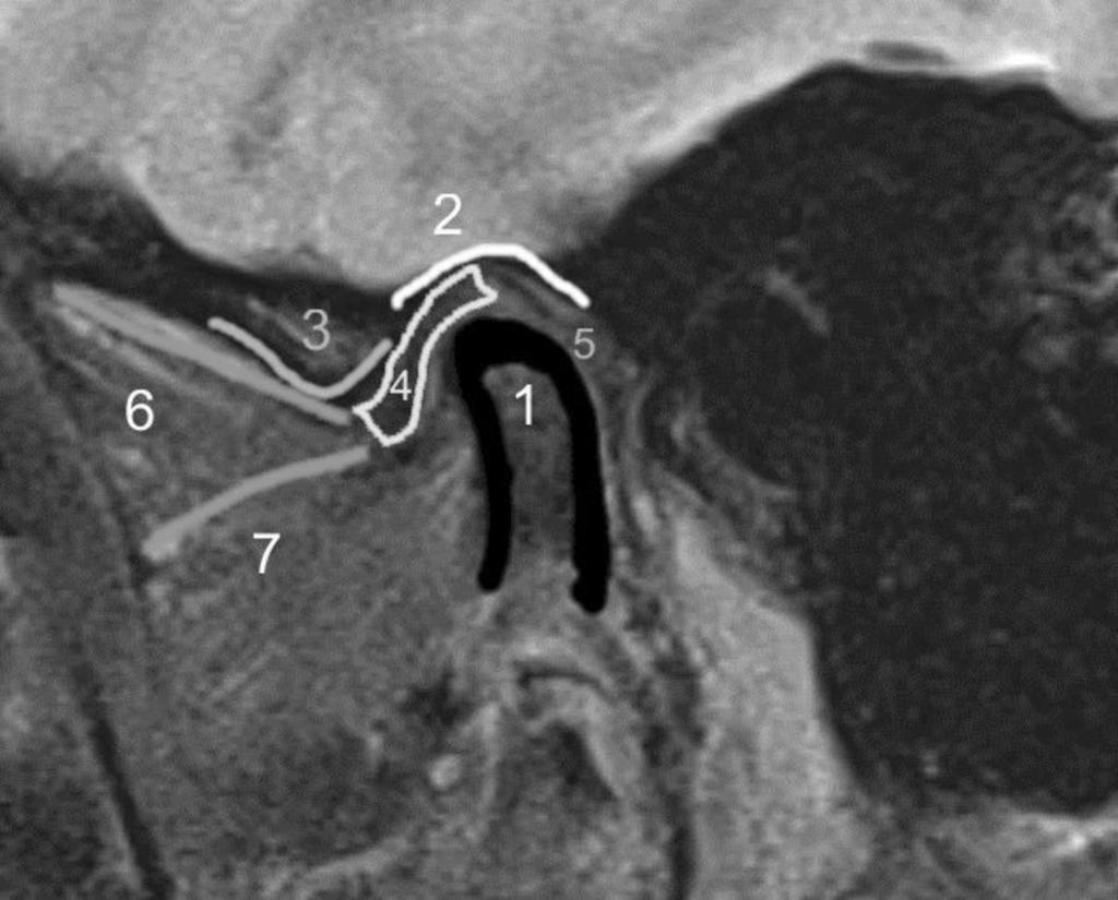 Fig. 2: Basic anatomy of the TMJ: 1 condyle; 2 temporal bone, mandibular fossa; 3 temporal bone, articular