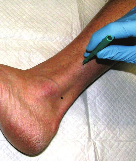 Let us help YOU make the diagnosis of small fiber peripheral neuropathy Epidermal Nerve