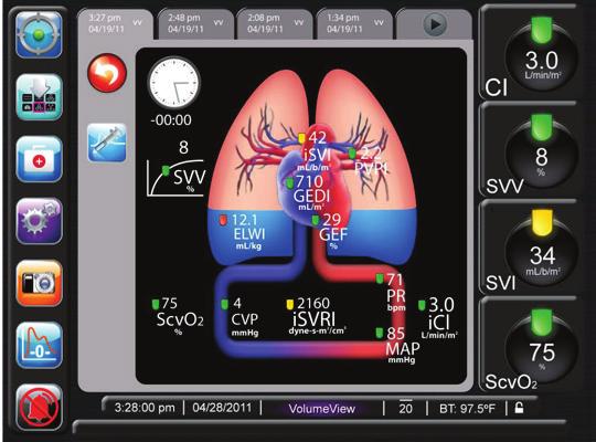 By delivering parameters visually as well as numerically, the EV1000 clinical platform allows you to more easily determine the root cause of a particular situation, further assisting and