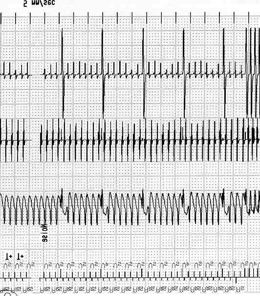 24 March 2002 Table 2. Technical data of the Arrhythmia Simulator (ARSI, HKP, Germany).