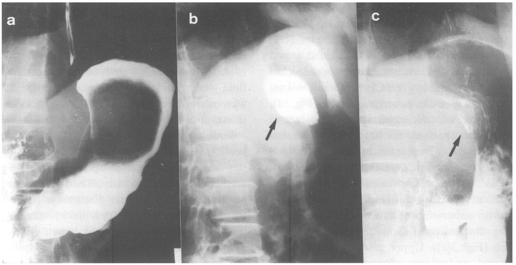 (c) A fistula and following small cavity two weeks after the treatment.