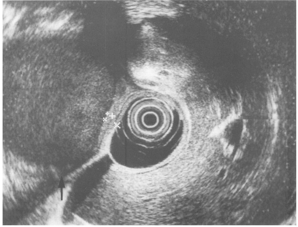 ENDOSCOPIC FENESTRATION OF PSEUDO CYST 159 FIGURE 5 EUS showed the cyst wall and stomach which was attached hard, and there was no vessels between them. forceps.