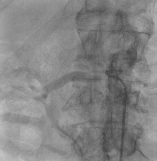 The Challenge of Accurately Stenting Aorto-Ostial Lesions In a retrospective study of 100 patients in whom stents were placed using angiographic landmarks, correct stent positioning was achieved in