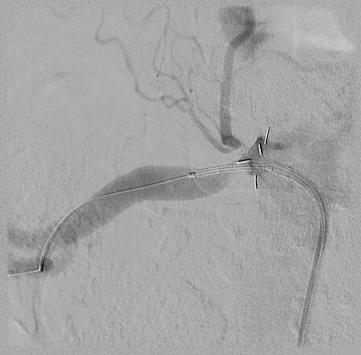 2 The accuracy of stent placement at the ostium by the Szabo technique was reported in 78 out of 257 cases of Medina (010-001) or aorto-ostial lesions. 3 Where is the ostium?