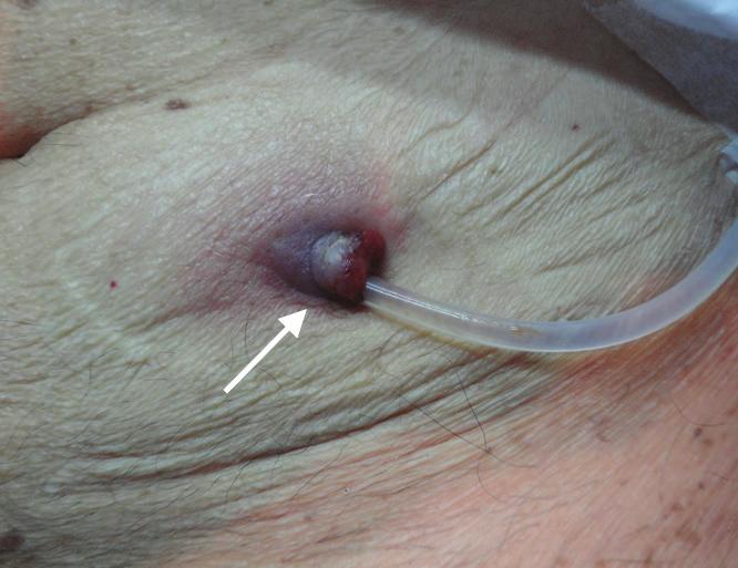 Figure 5. An extruded cuff protrudes from the exit site (arrow). is then brought out through the existing exit site using a curved clamp, and the procedure is completed.