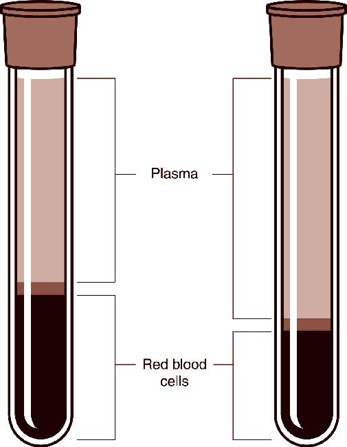 The best test to find out if you have anemia is to measure your blood level of hemoglobin. Hemoglobin is the part of your red blood cells that carries oxygen to all parts of your body.