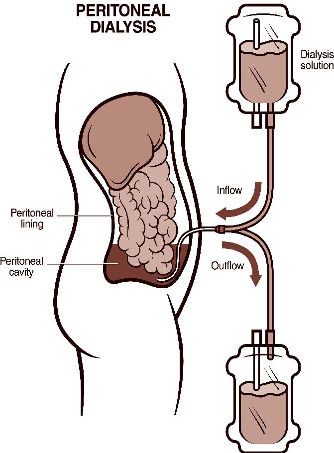 What Does Peritoneal Dialysis Do? Peritoneal dialysis, or PD, is one of the three treatments for kidney failure. The other treatments are hemodialysis and kidney transplant.