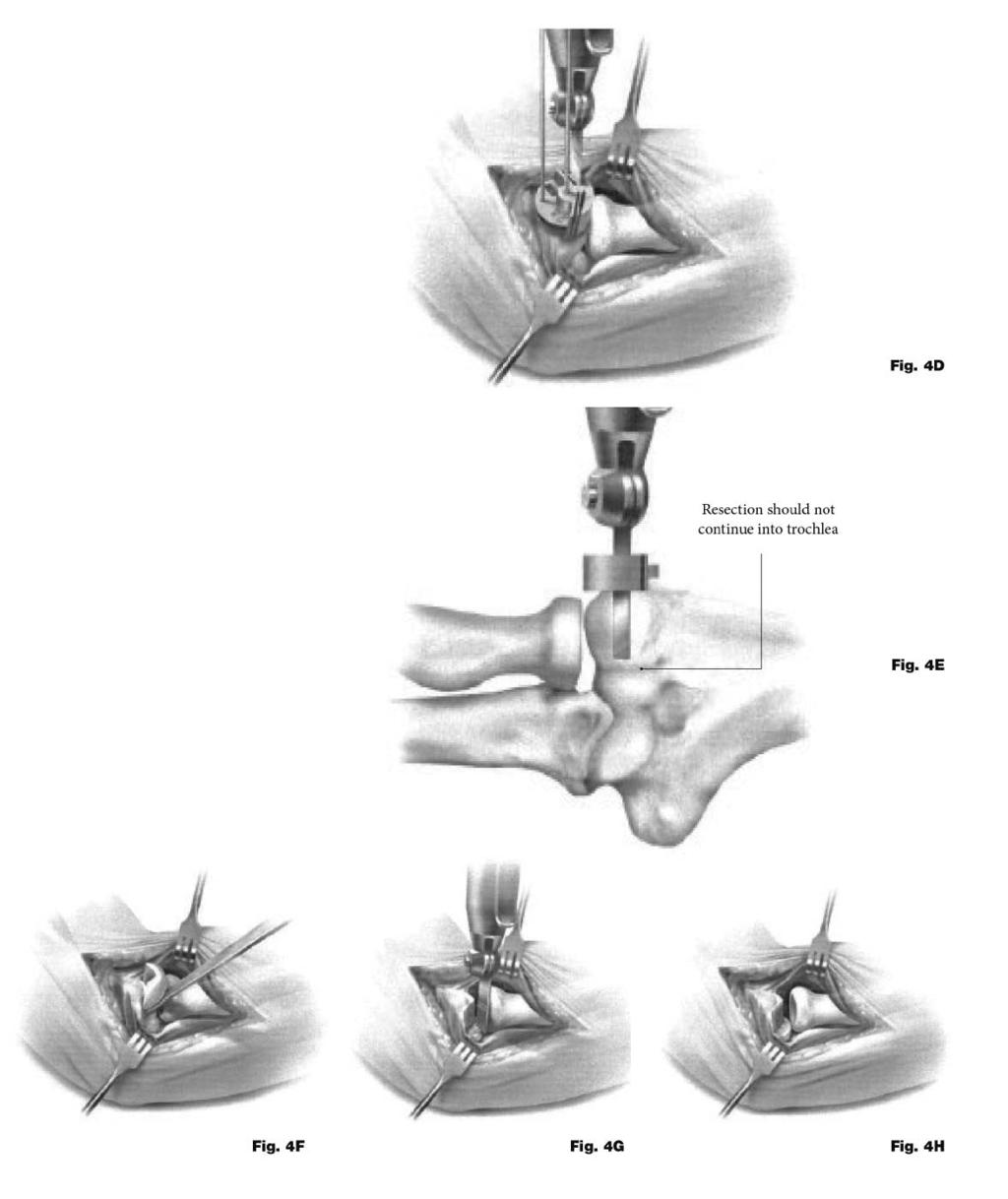 UNI-Elbow System Operative technique Operative technique Using a sagittal saw, insert the sawblade into the chosen slot in the resection guide. (Fig. 4D).