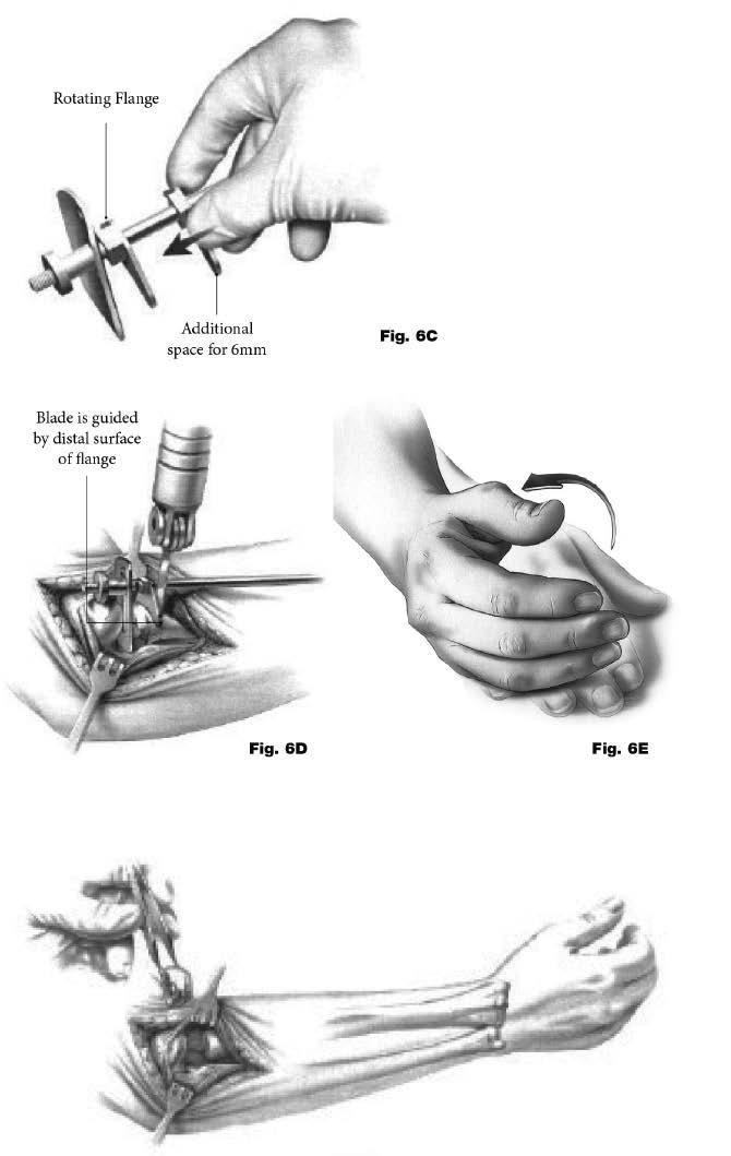 0798-2016 UniElbow Op tech (EMS-ST-1) - proof 3 Operative technique Operative technique UNI-Elbow System Using the radial head resection guide, 6mm extended collar If X-Ray templating is performed,