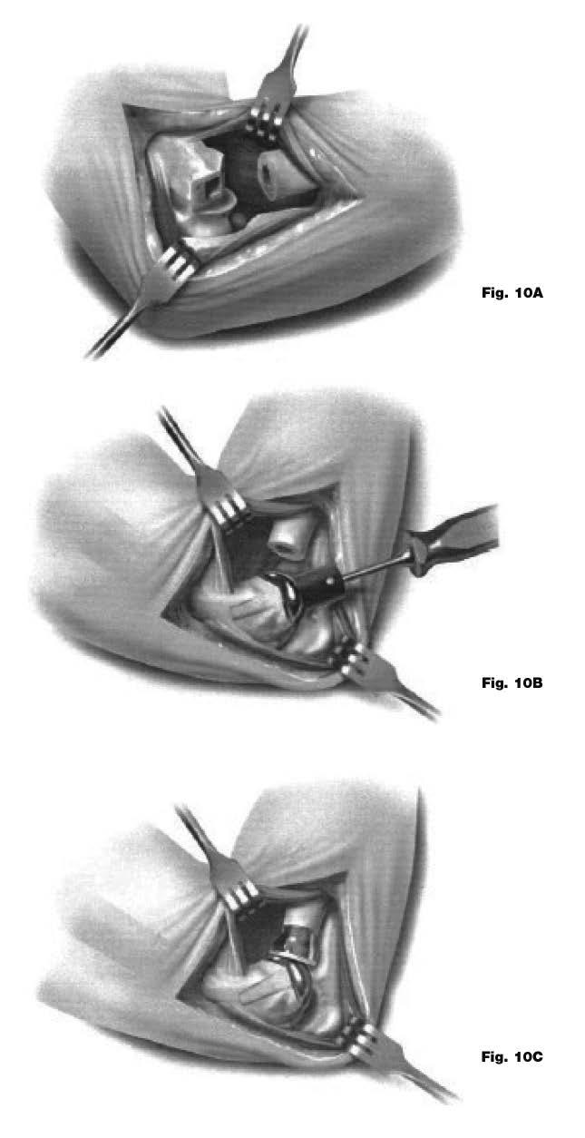 Operative technique Operative technique UNI-Elbow System rhead Radial (Morse Taper) option: Implanting the final components When using the UNI-Elbow, the polyethylene radial heads must be used at the