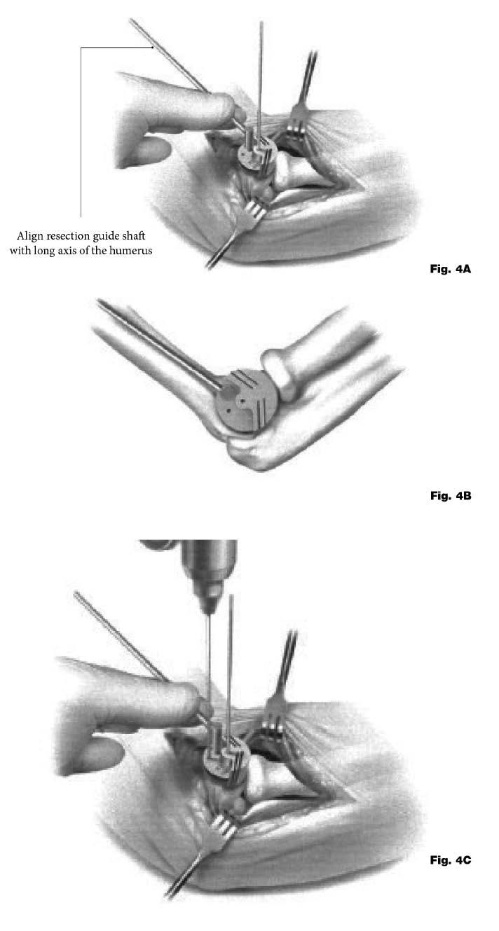 Operative technique Operative technique UNI-Elbow System Precise guidance technology (PGT) resection guide There are two resection guides, small and large.