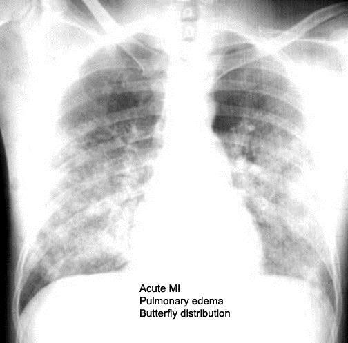 Chest X-Ray Cardiac