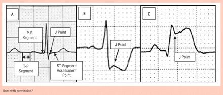 ST-segment elevation at the J point in two contiguous leads 0.25 mv in men below the age of 40 years, 0.2 mv in men over the age of 40 years, or 0.15 mv in women in leads V2 V3 and/or 0.
