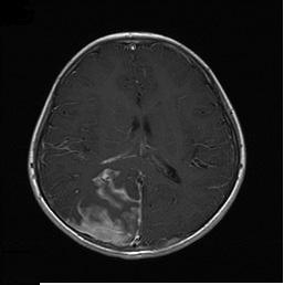 (Fig. 1). Brain magnetic resonance imaging demonstrated a low-intensity lesion on both T1- and T2-weighted images that appeared to be a sulcal hematoma.