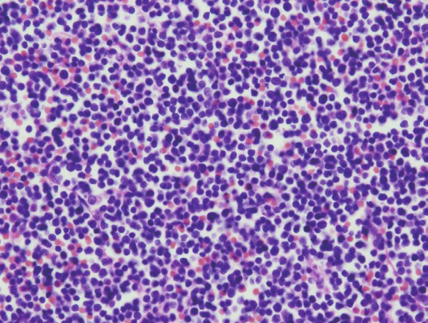 Isolated CNS Relapse of ALL A B C D Fig. 3. Photomicrographs of the tumor specimen. A: H&E stain ( 600).